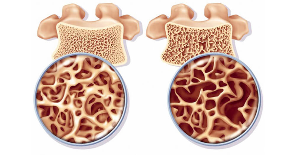 остеопороз заставка