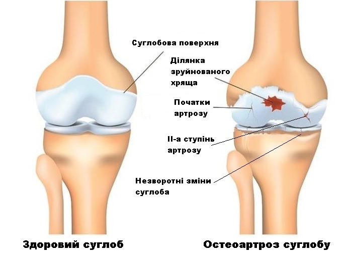 суглоб картинка